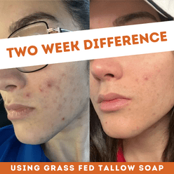 Side-by-side close-up images of a woman's cheek show visible acne improvement after two weeks using Health y Sol Tallow Soap. Text reads "TWO WEEK DIFFERENCE.