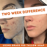 Side-by-side comparison of a cheek before and after two weeks using Health y Sol’s Tallow Soap shows visibly reduced acne and redness.